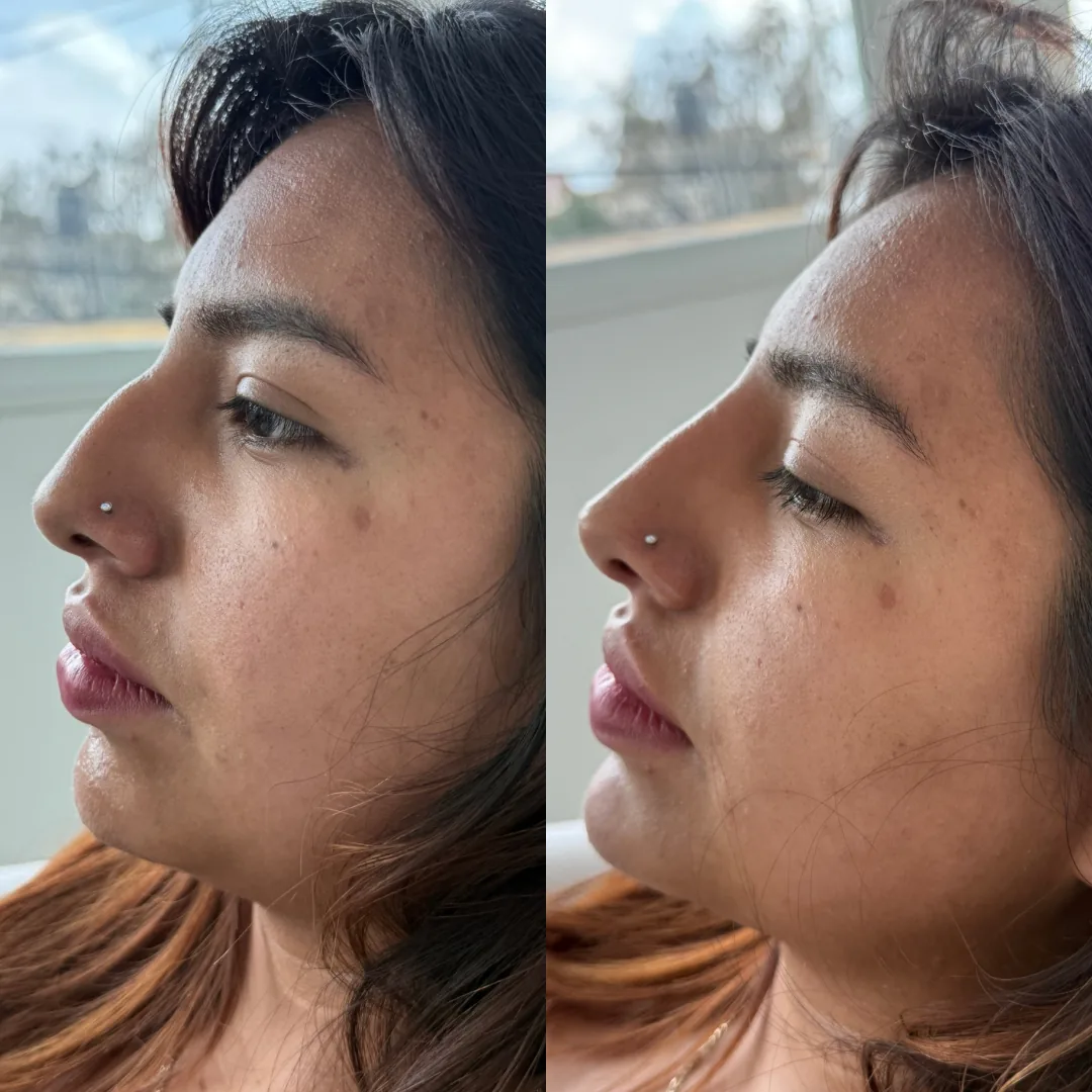 Resultado de diseño de labios - antes y después