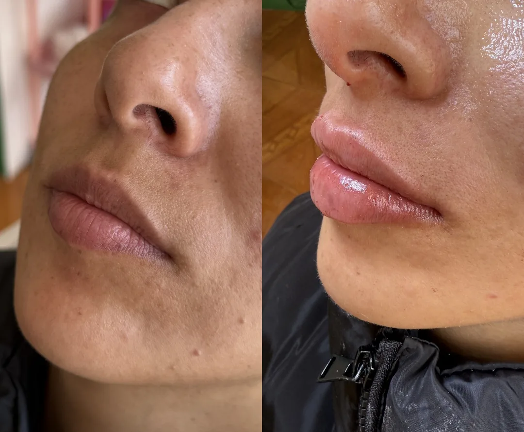 Resultado de diseño de labios - antes y después