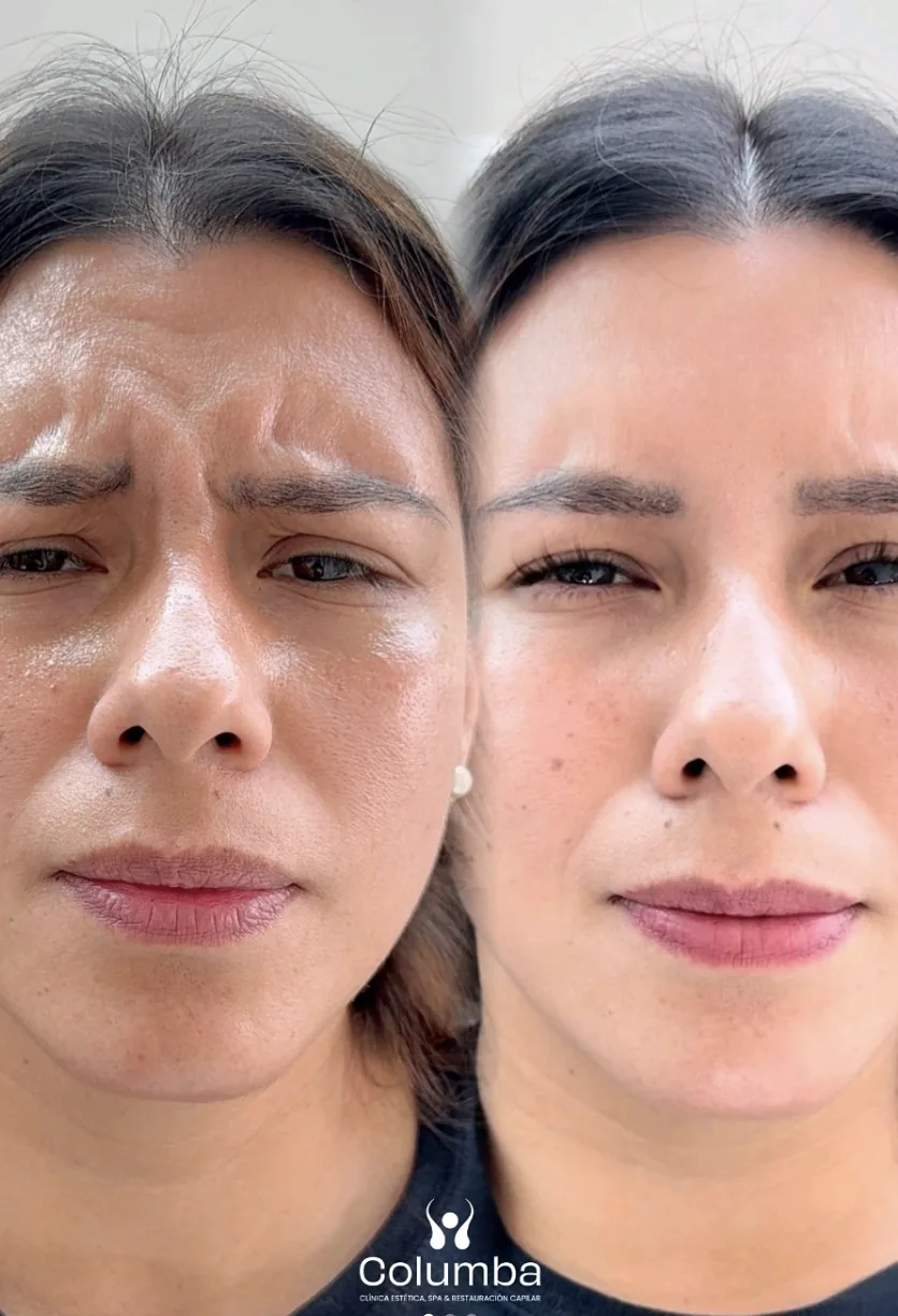 Resultado de botox en frente y entrecejo - antes y después