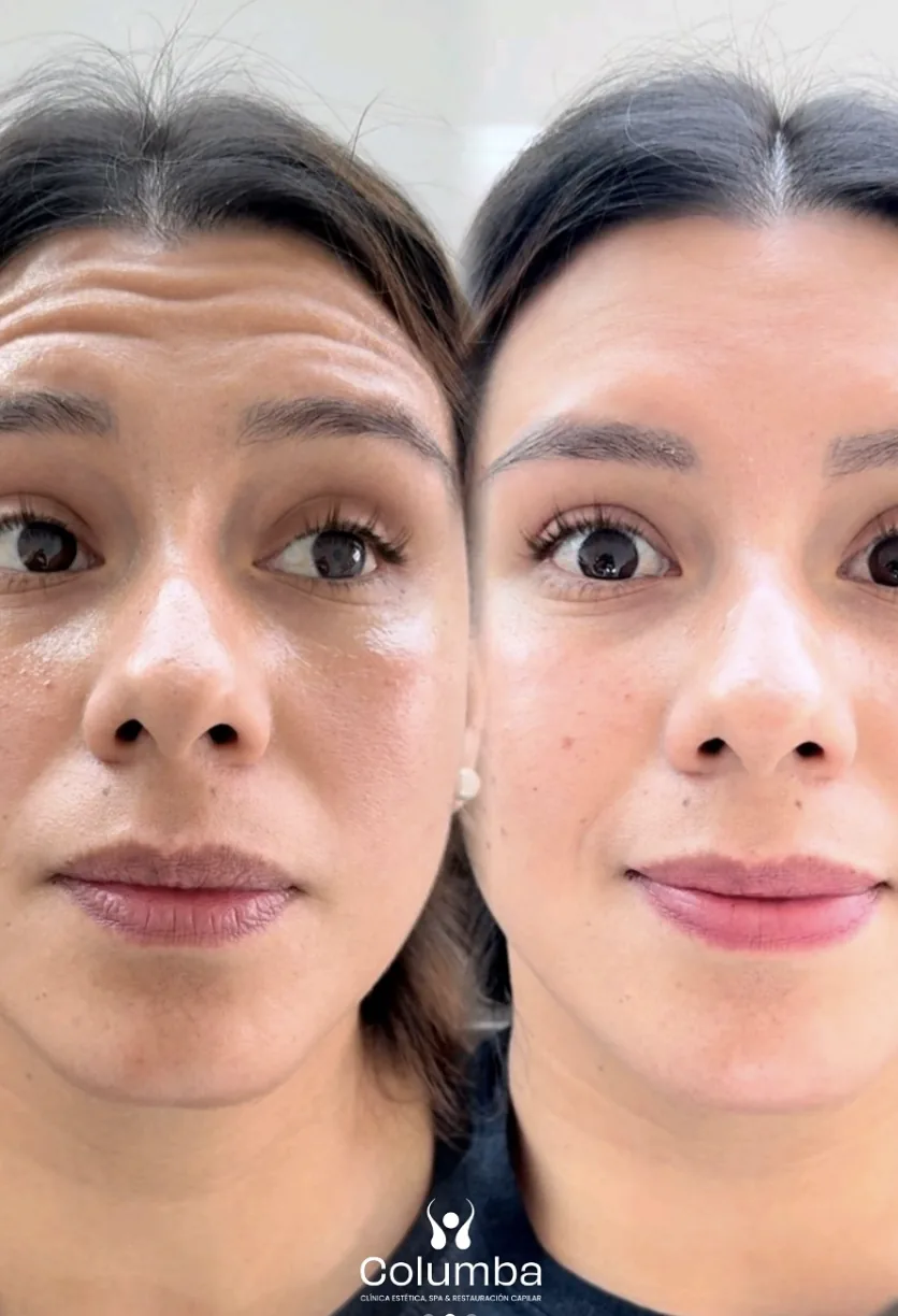 Resultado de botox en líneas de expresión - antes y después