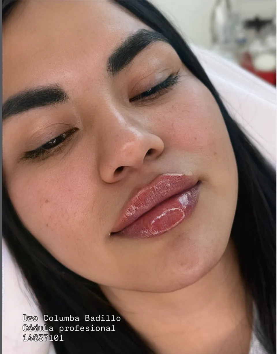 Resultado de diseño de labios con relleno dérmico